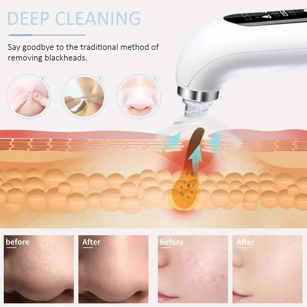 Blackhead Vacuum Suction Remover Rieworkes