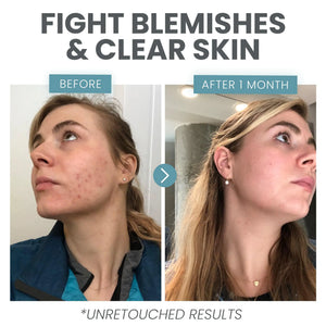 Vitamin C Serum for Face - Skin Clearing Serum with Salicylic Acid Retinol, Niacinamide and Hyaluronic Acid - Skin Brightening Acne Serum - Anti Aging Dark Spot Treatment(1 oz) 1 Fl Oz (Pack of 1) Rieworkes
