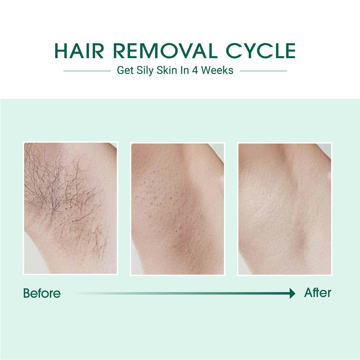 Laser IPL Hair Removal Mimarta