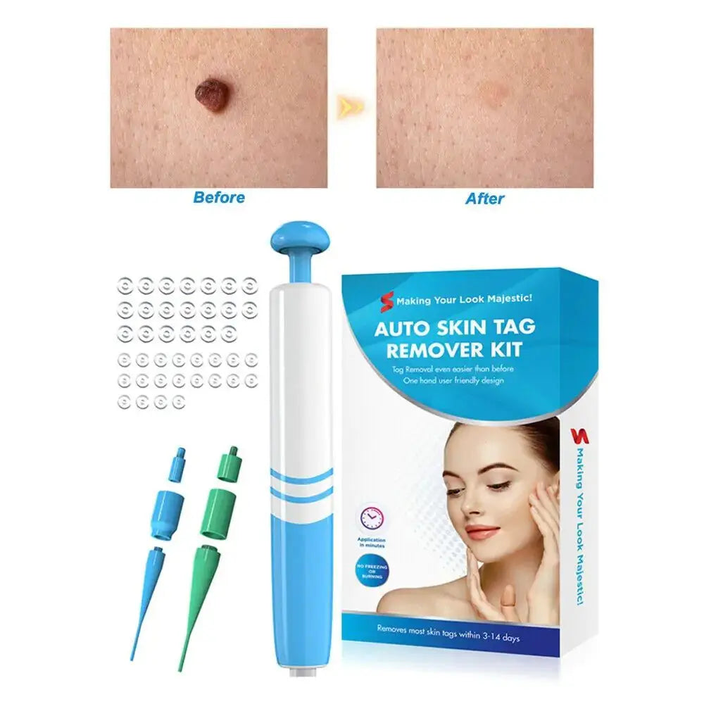 Painless Wart Removal Kit Rieworkes