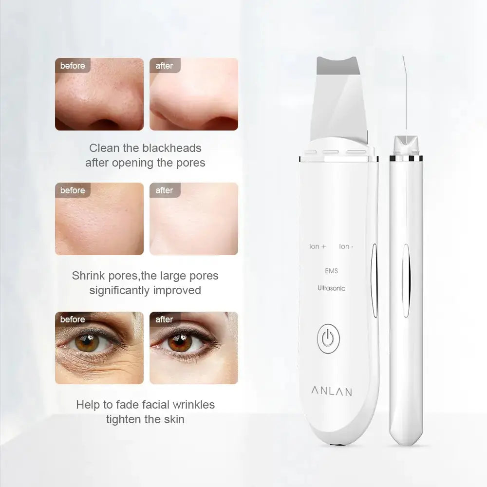 Ultrasonic Skin Lift Machine Rieworkes